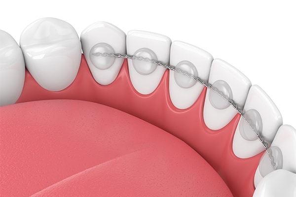 Fixed Retainers Orthodontics by Bradford in Palm Beach Gardens, Palm City, and Lake Worth, FL