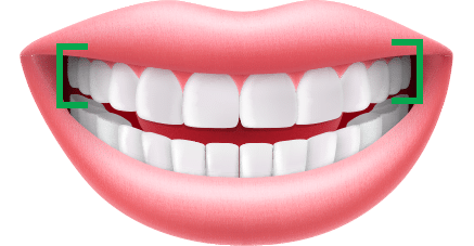Assessment Front Teeth Display Orthodontics by Bradford in Palm Beach Gardens, Palm City, and Lake Worth, FL