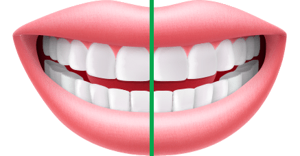 Assessment Midline Symmetry Orthodontics by Bradford in Palm Beach Gardens, Palm City, and Lake Worth, FL