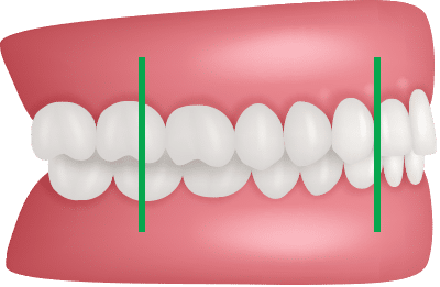 Assessment Occlusion Orthodontics by Bradford in Palm Beach Gardens, Palm City, and Lake Worth, FL