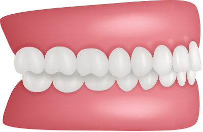 Assessment Teeth Alignment Orthodontics by Bradford in Palm Beach Gardens, Palm City, and Lake Worth, FL